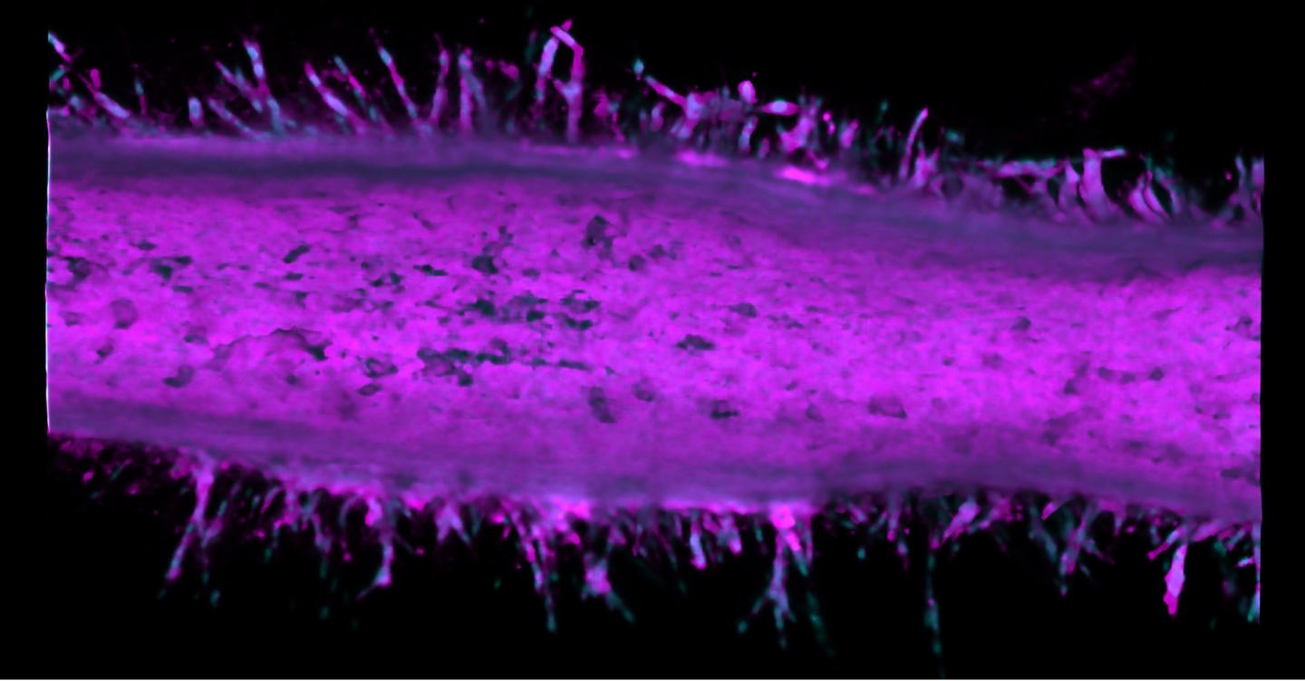 Invasive Pancreatic Cancer