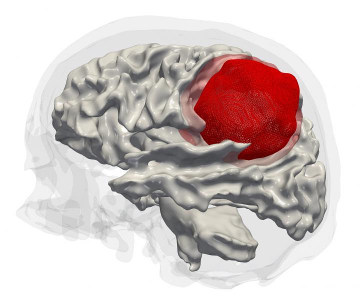 Aggressive Brain Tumor (Glioblastoma)