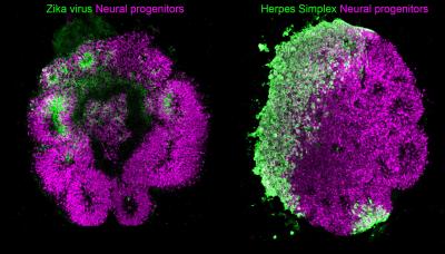 Human brain organoids infected by Zika virus and Herpes Simplex Virus-1