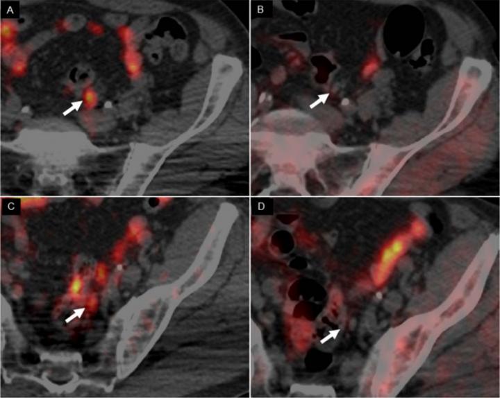 Comparison of 64CuCl2-PET/CT and 18F-Choline PET/CT Images of a 62-year-old Man