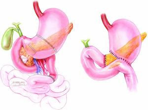 Illustration of the reconstruction before and after the Whipple procedure, pancreaticojejunostomy,