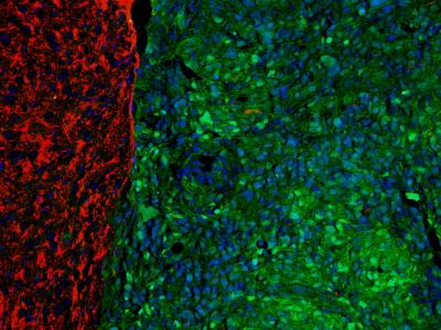 Brain Tumor Cells in Mouse Model