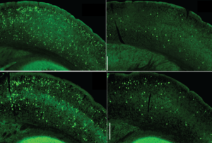 Key Signaling Pathway in Immune Cells Could be New Alzheimer’s Target