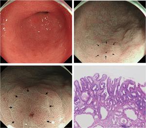 LM-NBI detected diminutive lesion