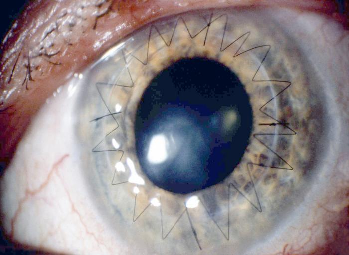 Eye after cornea transplant