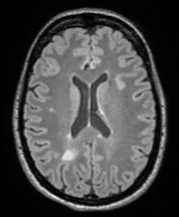 MRI scan of the brain of a patient with multiple sclerosis.