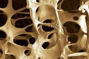 Osteoclasts are involved in osteoporosis and many other bone diseases.