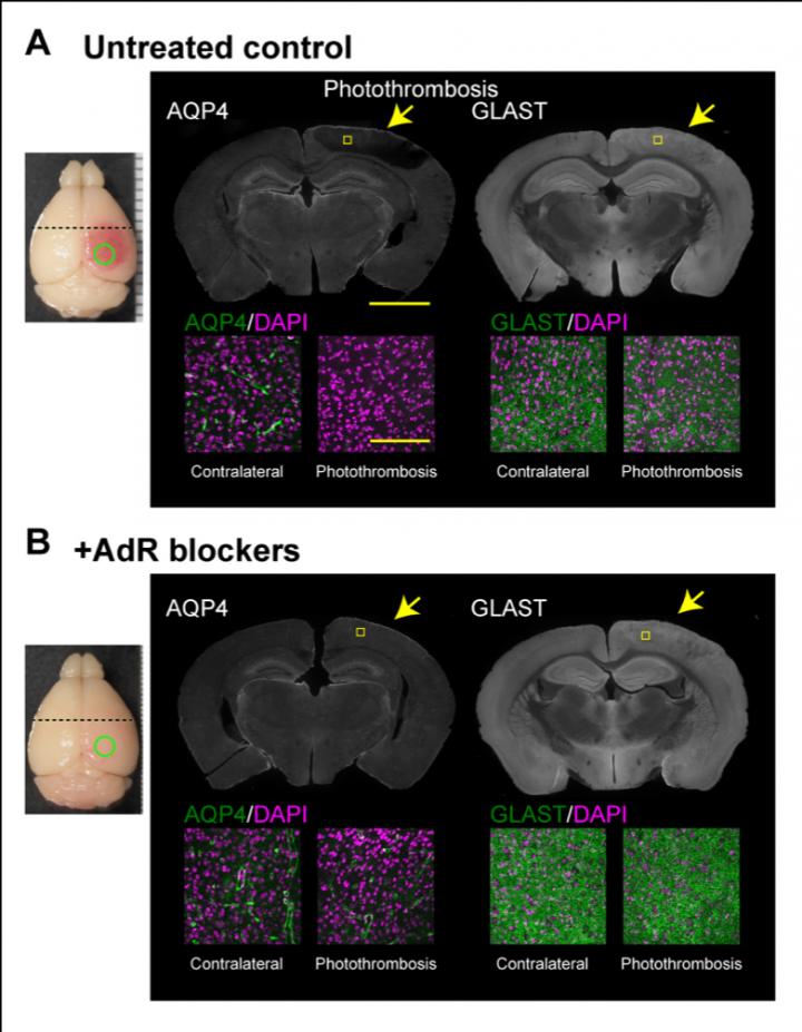 Adrenergic Blockers Induce Neuroprotection and Facilitate Recovery from Acute Ischemic Stroke