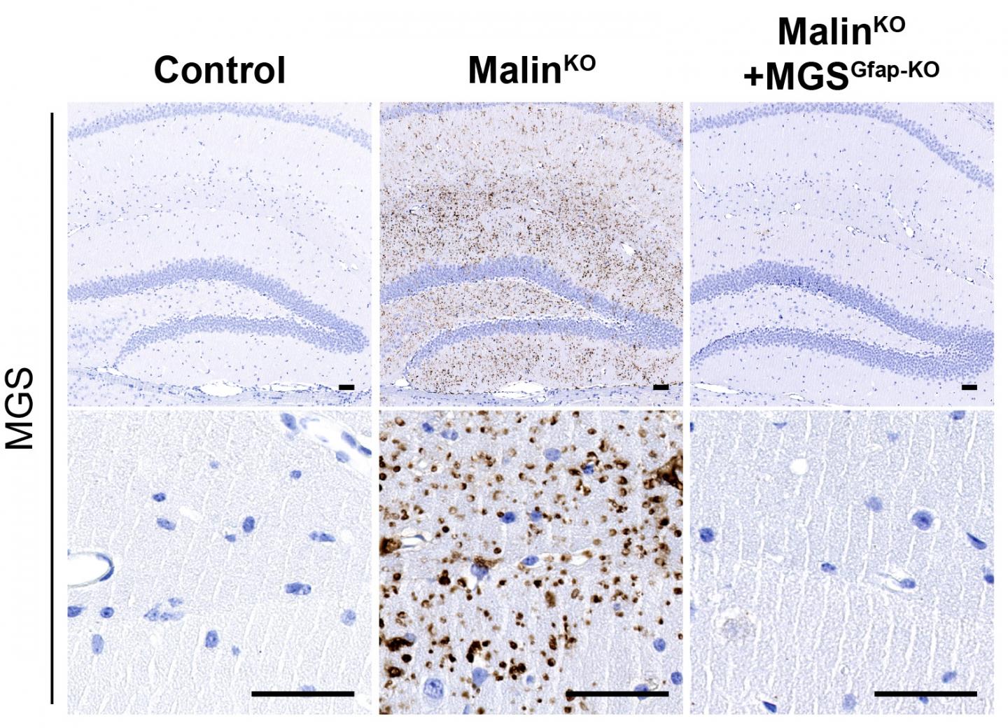 Lafora bodies in brain sections (hippocampus).