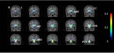 Neuroinflammation of Patients with Chronic Fatigue Syndrome/Myalgic Encephalomyelitis