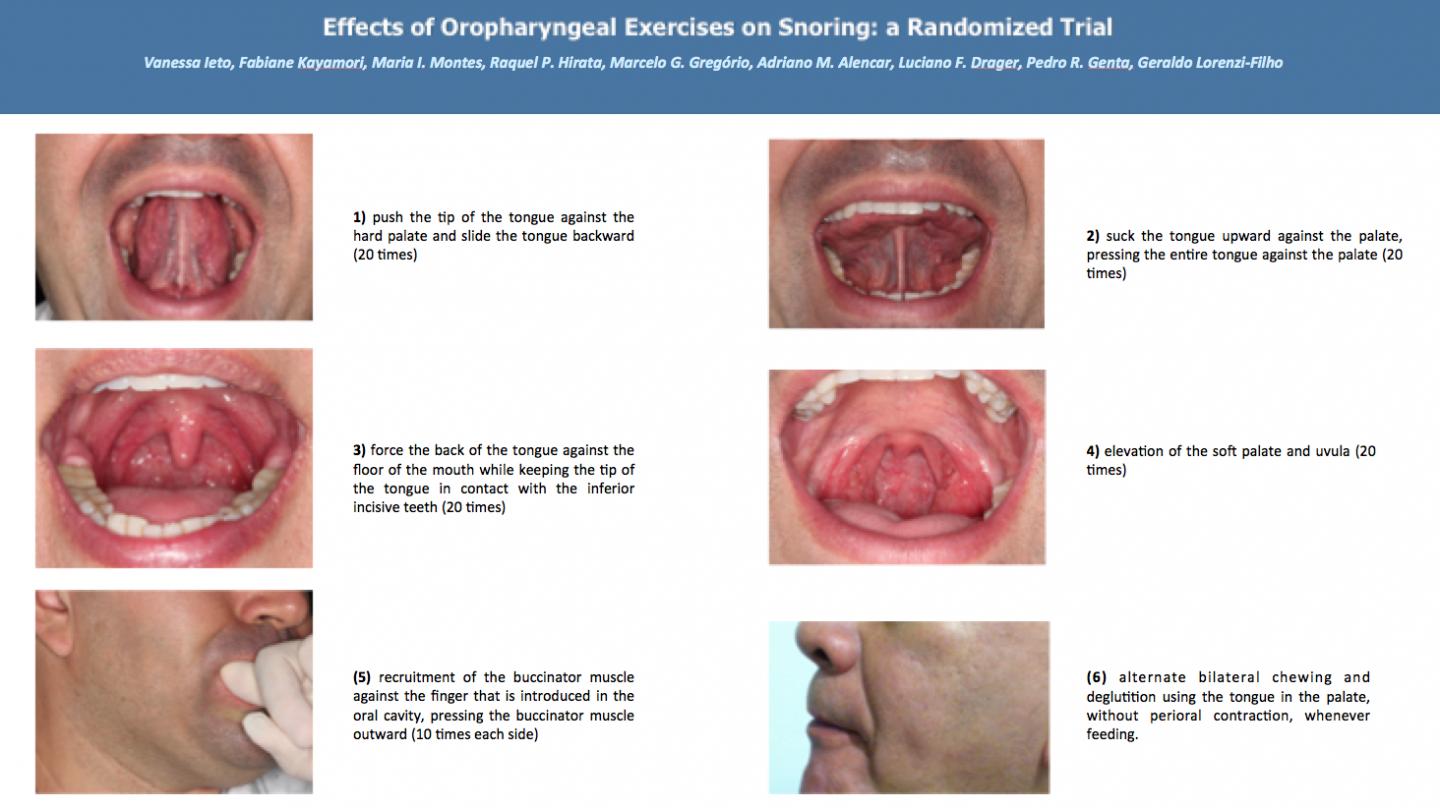 Oropharyngeal Exercises Curb Snoring