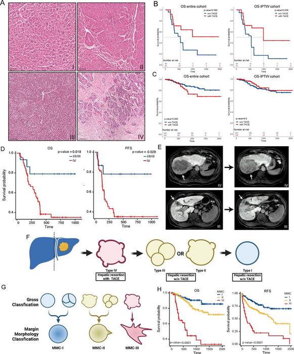 Gross classification guiding HCC therapy.