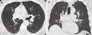 Airway changes in a marijuana and tobacco smoker.