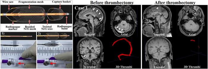 Demonstration of Venus-TD and thrombectomy process in CVST patient.