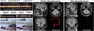 Demonstration of Venus-TD and thrombectomy process in CVST patient.