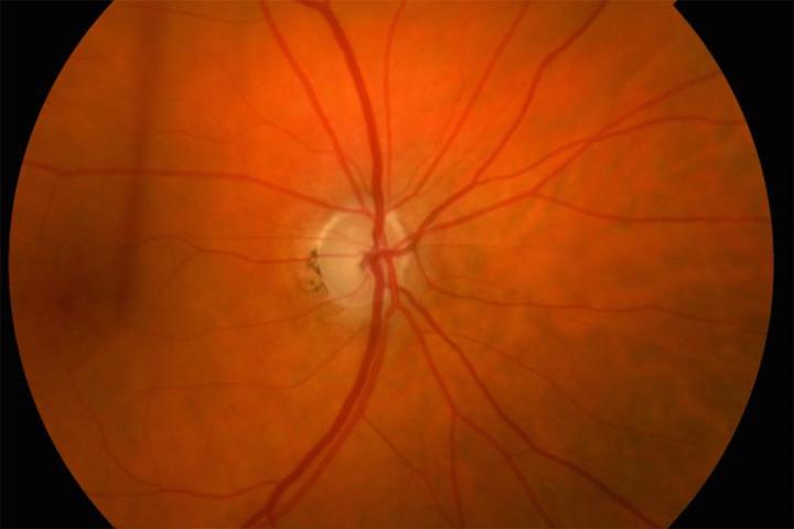 Glaucomatous Optic Nerve