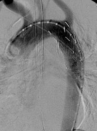 Aorta Angiogram, Figure 2