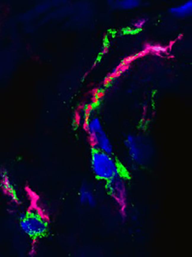 NETs in a COVID-19 Patient's Lungs