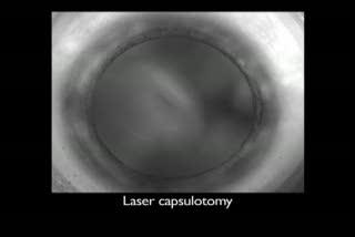 3-D Imaging Guides Femtosecond Laser in Cataracts Removal (9 of 10)