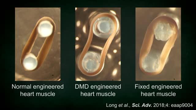 CRISPR Corrects Array of Duchenne Muscular Dystrophy Mutations (2 of 3)