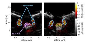 Photoacoustic images of the ulnar (left) and median (right) nerves from a swine recorded in vivo for the first time.