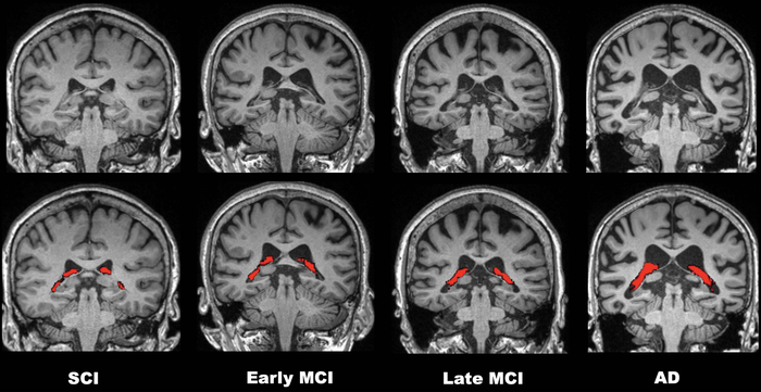 Choroid Plexus Volume Linked to Alzheimer’s Disease