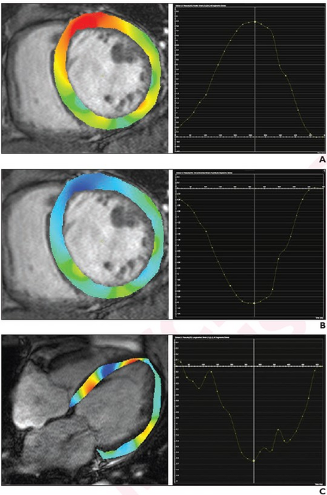 Right Ventricular Global Longitudinal Strain Provides Prognostic