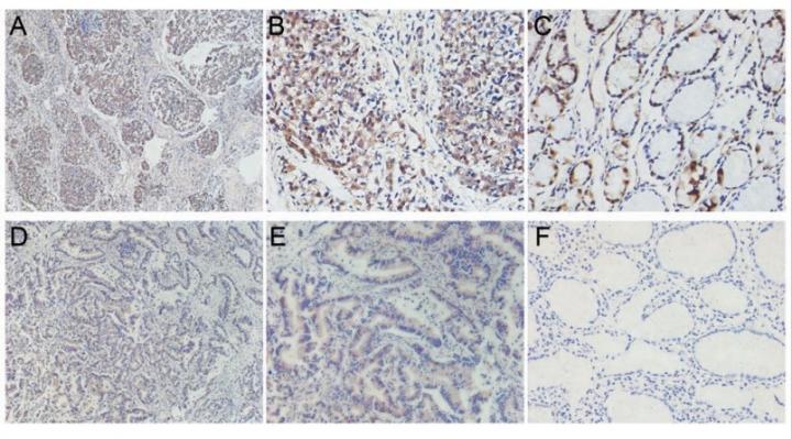 Biomarkers May Help Predict Outcomes in Gastric Cancer Patients Who Abuse Alcohol