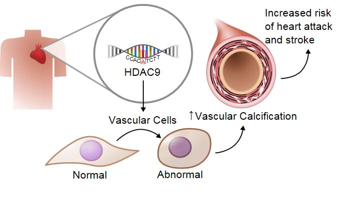 Gene Linked to Aortic Calcification and Cardiovascular Disease