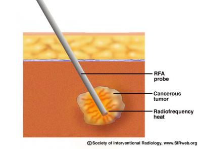 Radiofrequency Ablation Probe