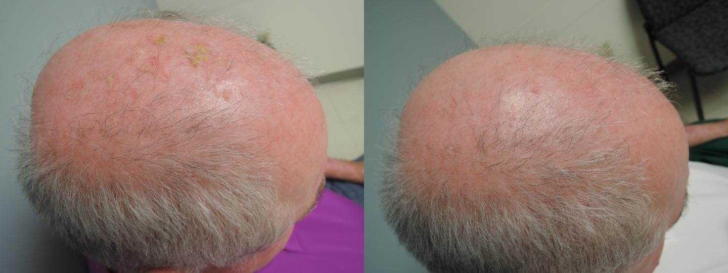 actinic keratosis scalp systems