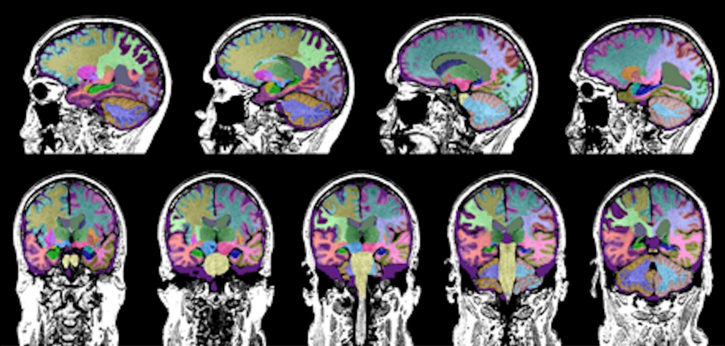 MRI Scans of Study Participants with TBI