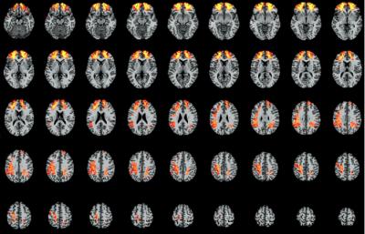 Brain Imaging [IMAGE] | EurekAlert! Science News Releases