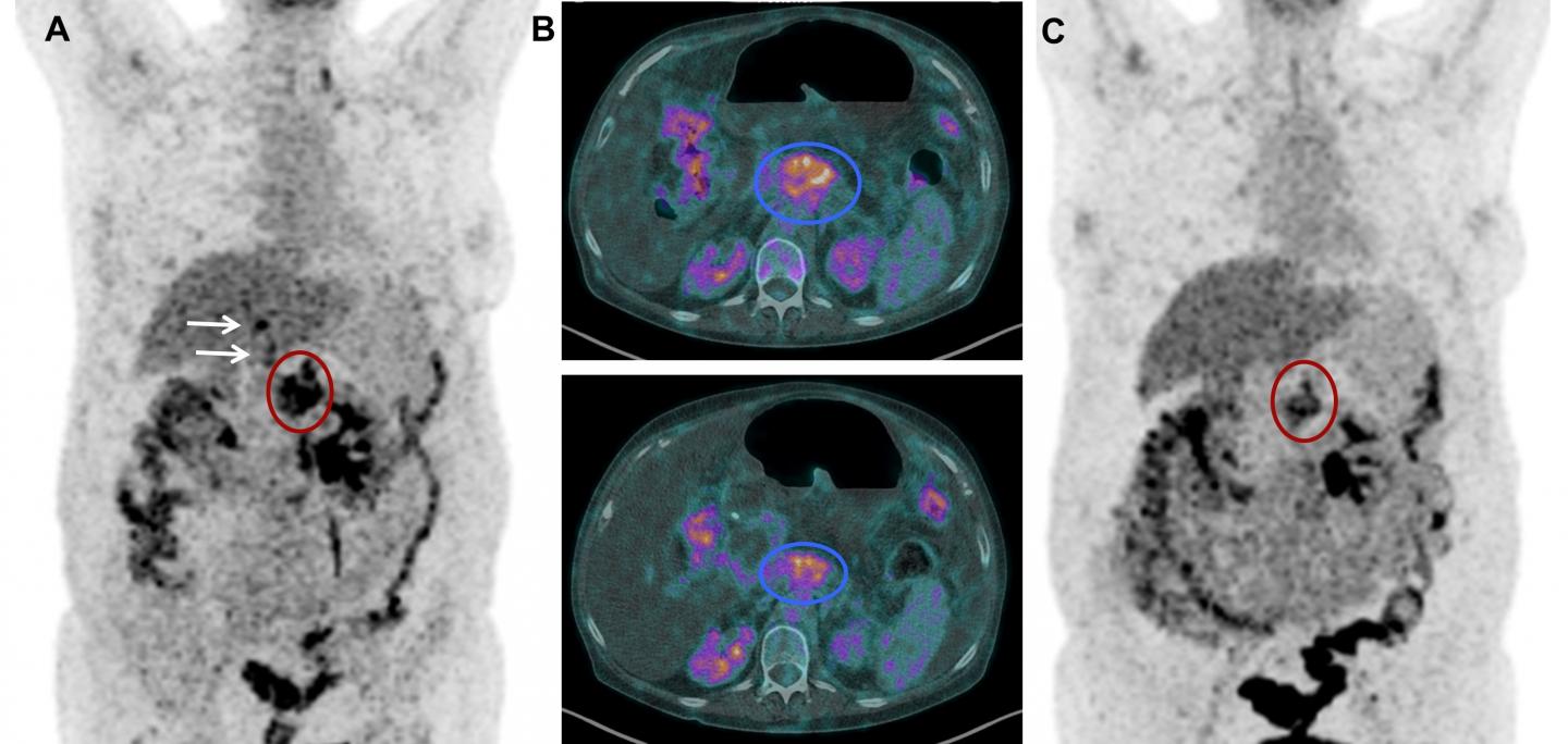 <sup>18</sup>F-FDG PET and CT scans of patient before and after <sup>177</sup>Lu-3BP-227 Therapy