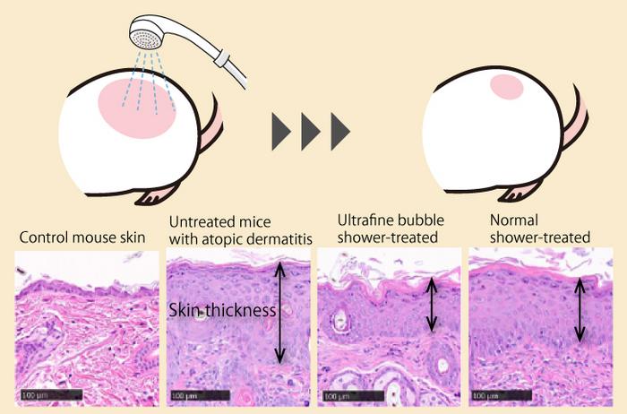 Ultrafine bubble showers and atopic dermatitis