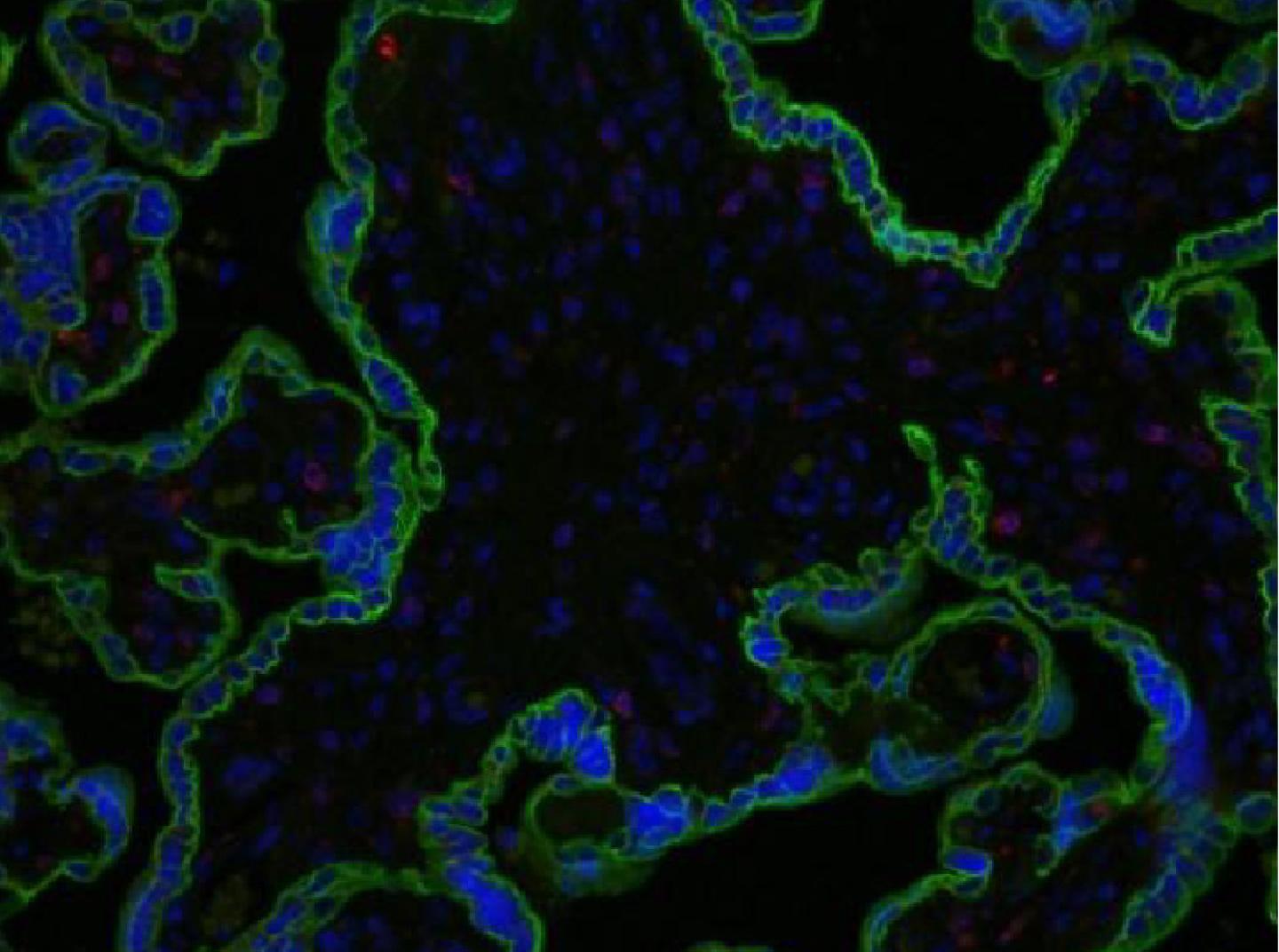 CD74 in the Preeclamptic Placenta