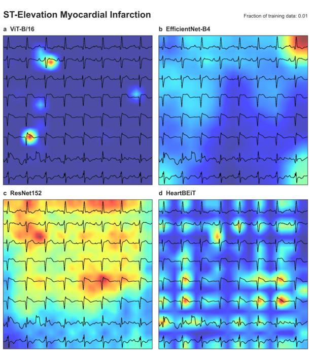 Diagnosing heart attacks with new AI model