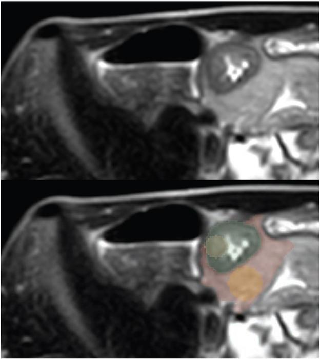 17-year-patient with Crohn disease