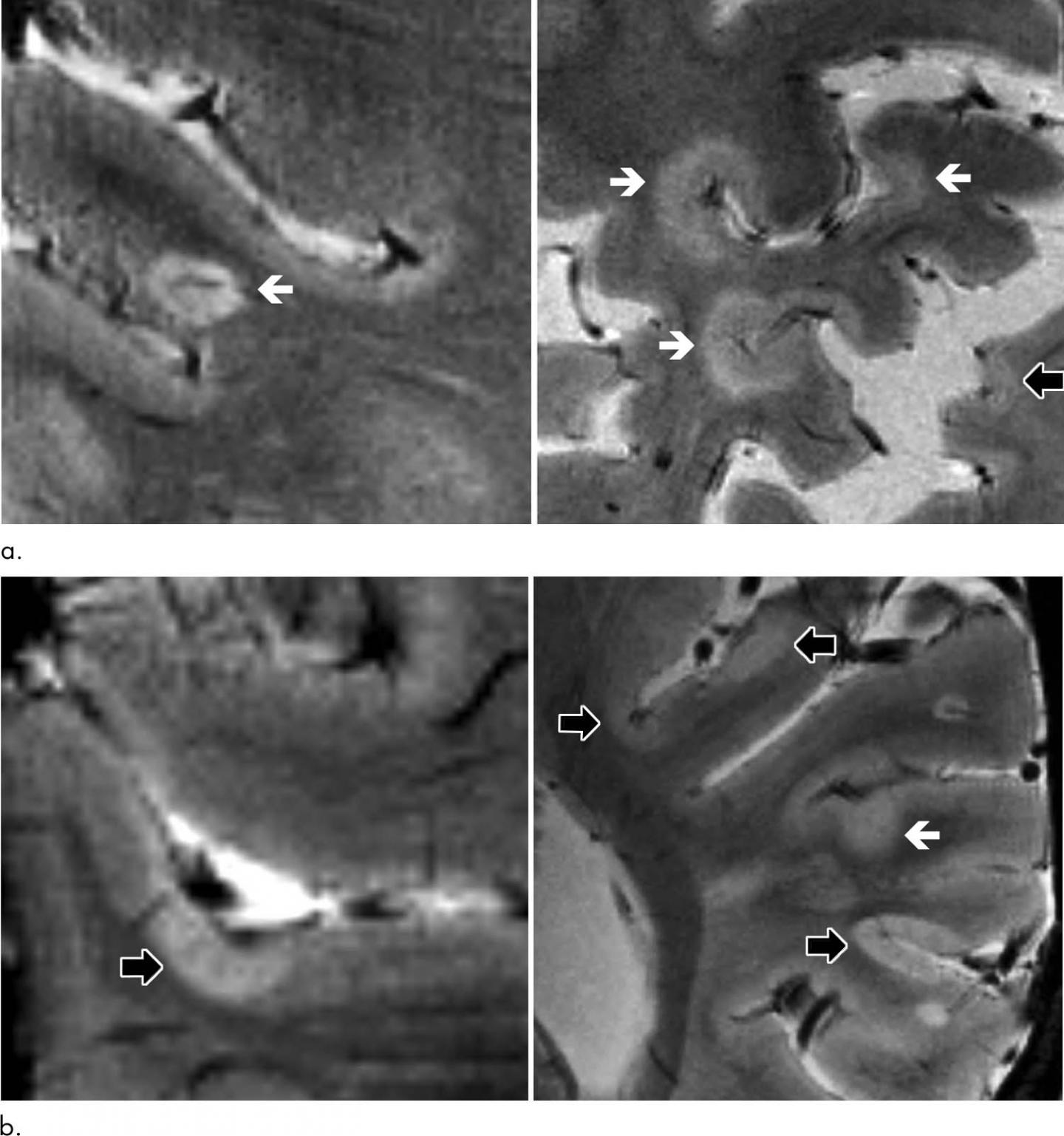 High-Strength MRI Tracks MS Progression