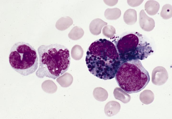 Acute Myeloid Leukemia
