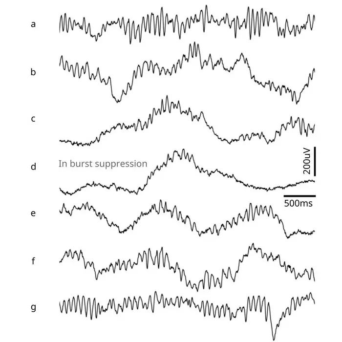 study-finds-tracking-brain-waves-could-reduce-eurekalert