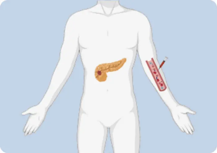 Graphical representation of pancreatic incidentaloma and liquid biopsy.