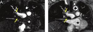 MR Angiography as the Preferred Test for Pulmonary Embolism During the Iodinated Contrast Media Shortage of 2022: A Single-Center Experience