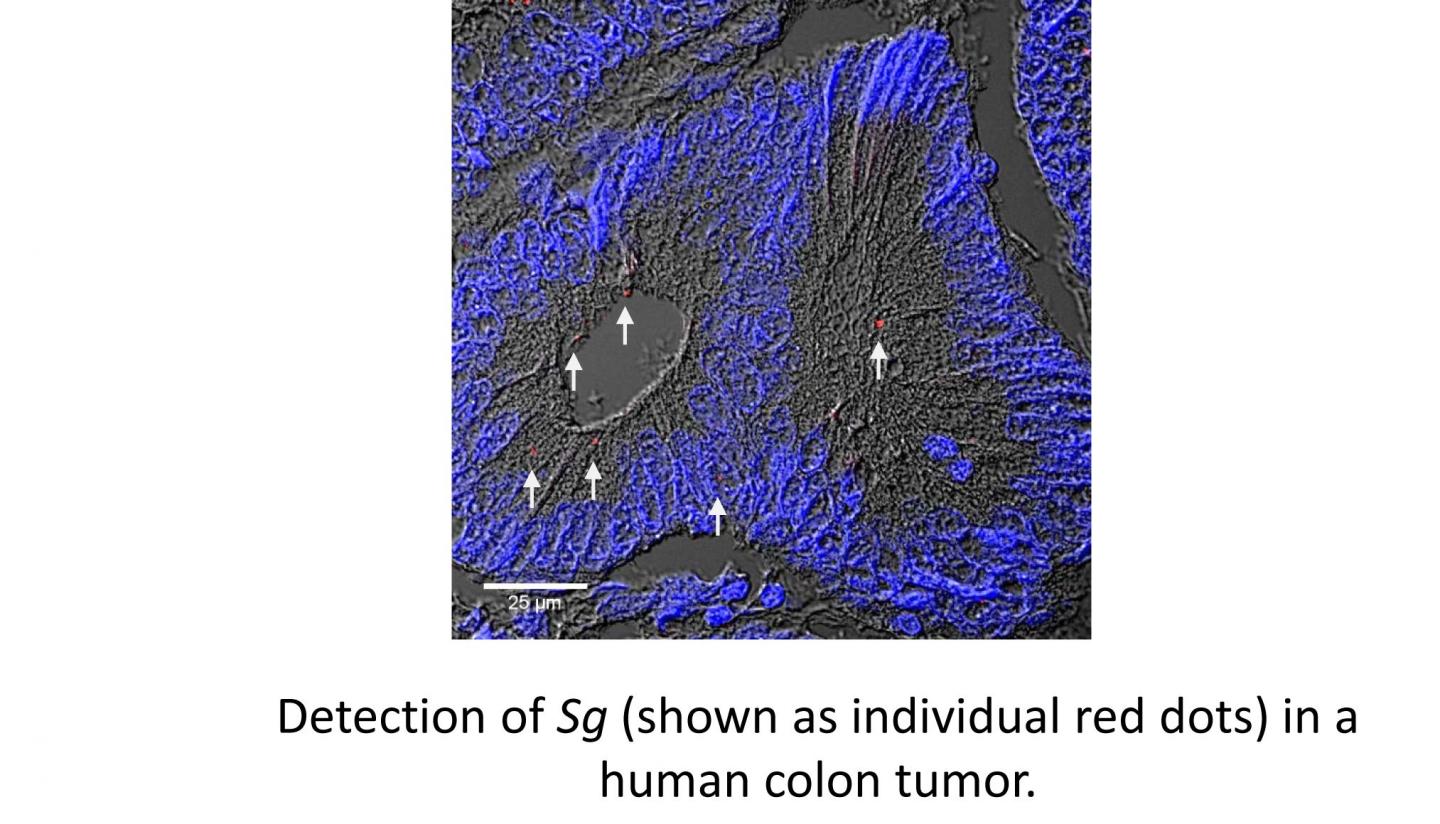 Bacterium Actively Drives Colorectal Cancer Tumor Cell Growth