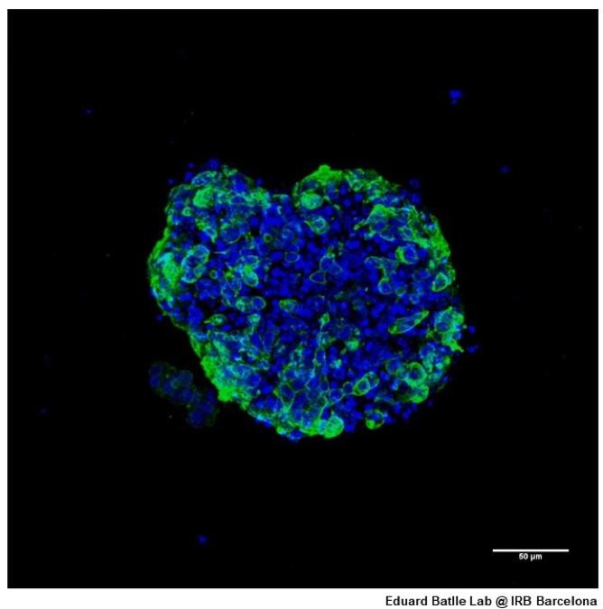 Human Organoid Derived from Colon Cancer