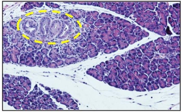 Pre-Cancerous Lesion