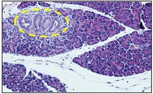 Pre-Cancerous Lesion