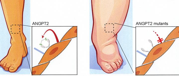 Lymphedema