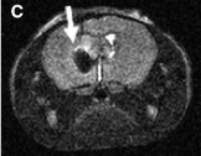 Brain Tumor with Nanoparticles