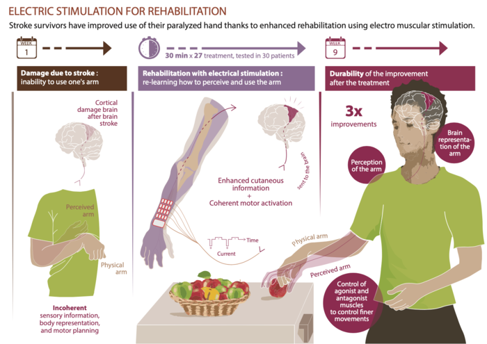 Infographic Stroke Rehabilitation